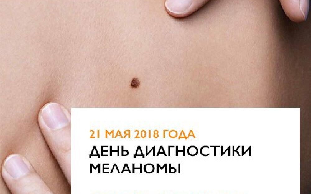 В Барнауле пройдет бесплатное обследование родинок на меланому