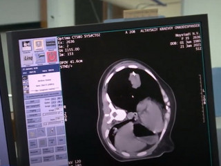 В Алтайском крае расширили возможности компьютерной томографии при диагностике онкозаболеваний легких